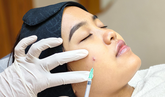 Platelet-Rich Fibrin (PRF)