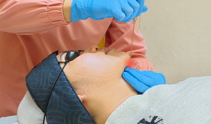 Platelet-Rich Fibrin (PRF)